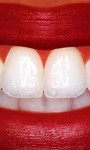 Remove a lot of the plaque on your teeth with amazing teeth whitening systems